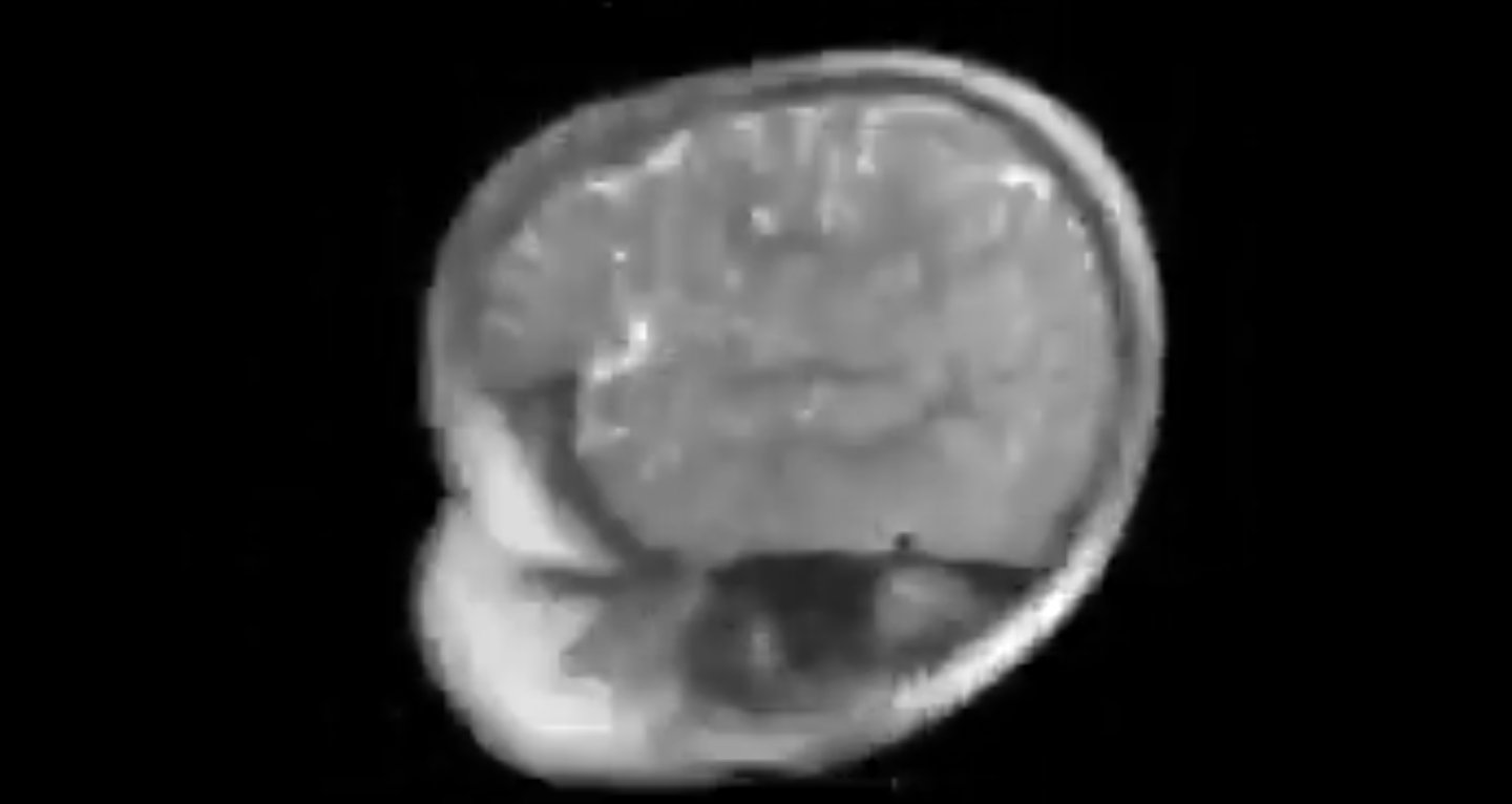 Camus study highlights frightening damage to the brains of device focused children